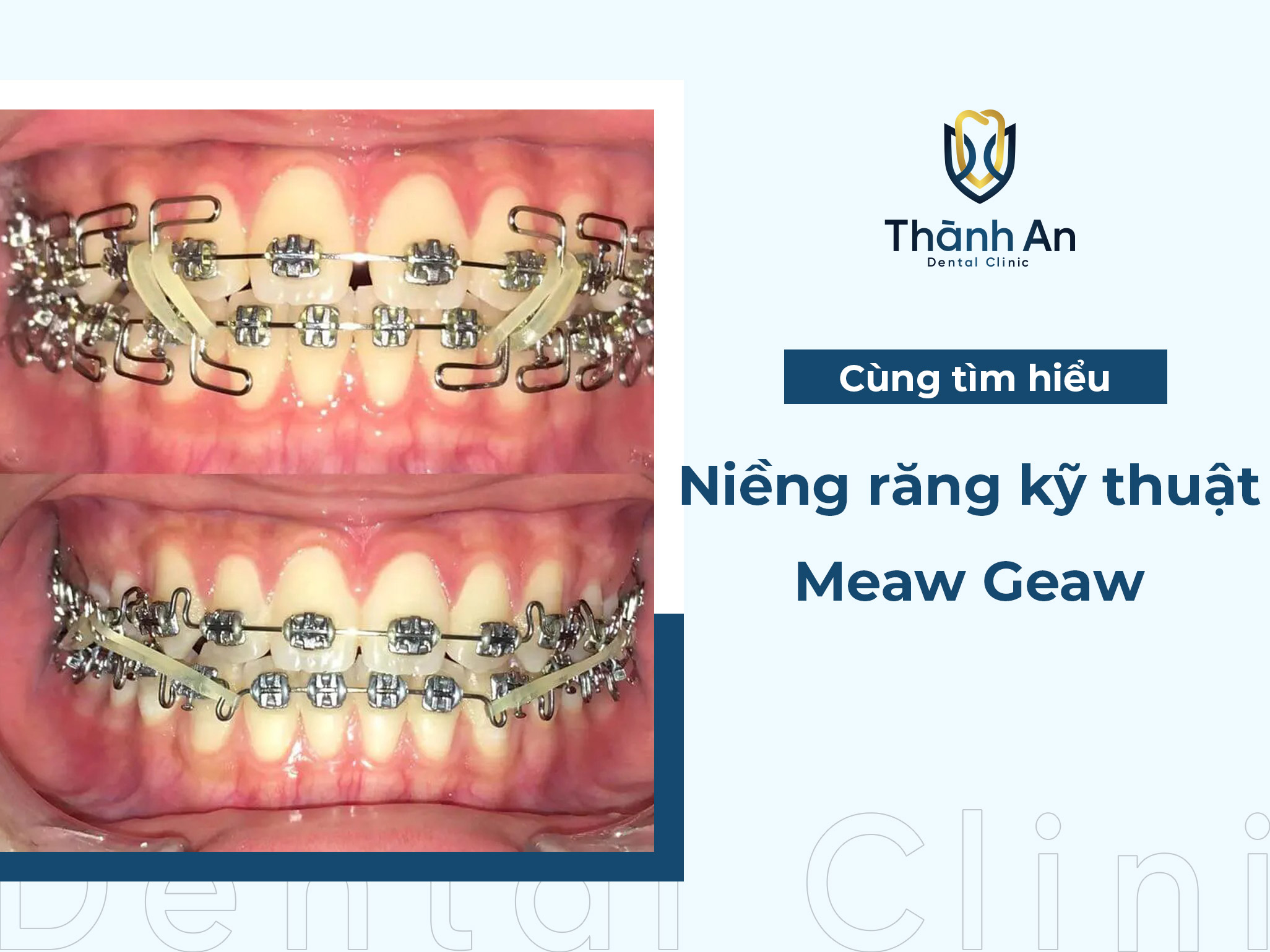 Niềng răng kỹ thuật Meaw - Geaw là gì? 