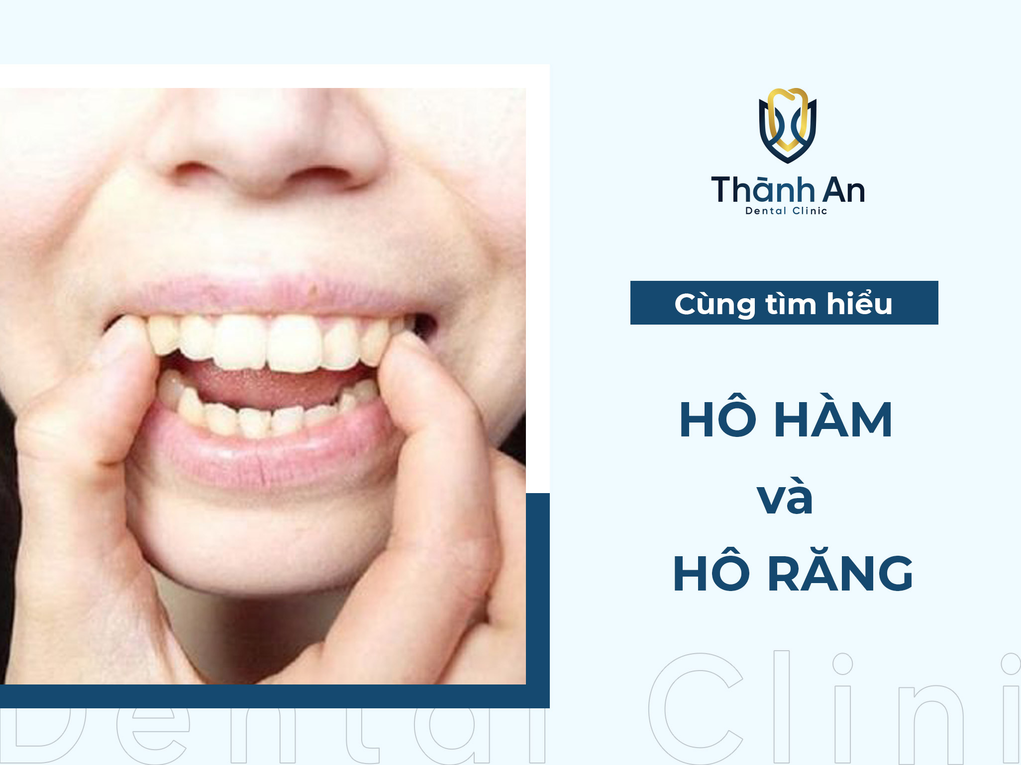 Hô hàm và hô răng: Cách nhận biết và điều trị phù hợp theo tình trạng hô