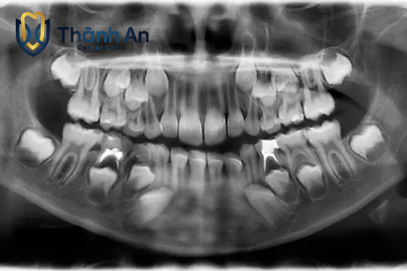 Chụp X Quang Răng