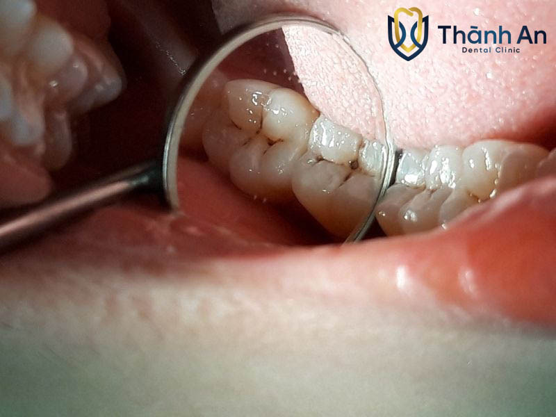 giá điều trị viêm tủy răng