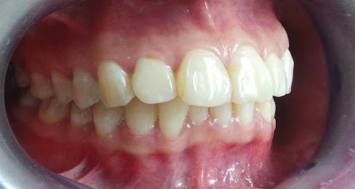 hô hàm và hô răng